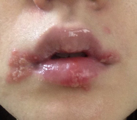 헤르페스 1형 입술 증상